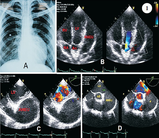 Chest X-ray showing prominent bulge in the mid left cardiac border (Panel A), Modified apical 5-chamber view showing aneurysmal cavity (ANEU) along with normal 4 chambers (Panel B), Transgastric short axis view by trans-oesophageal echocardiography showing compression of left ventricle by aneurysm (Panel C), Trans-oesophageal short axis view demonstrating origin of aneurysm (Arrow) from left atrium (Panel D).