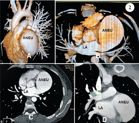 Volume reconstruction of a 64-slice multidetector cardiac CT imaging showing location of aneurysm antero-superior and left to the left ventricle (Panels A & B), A 64-slice multidetector cardiac CT imaging measurements of aneurysm size of 51 x 66 mm (Panel C & D).
