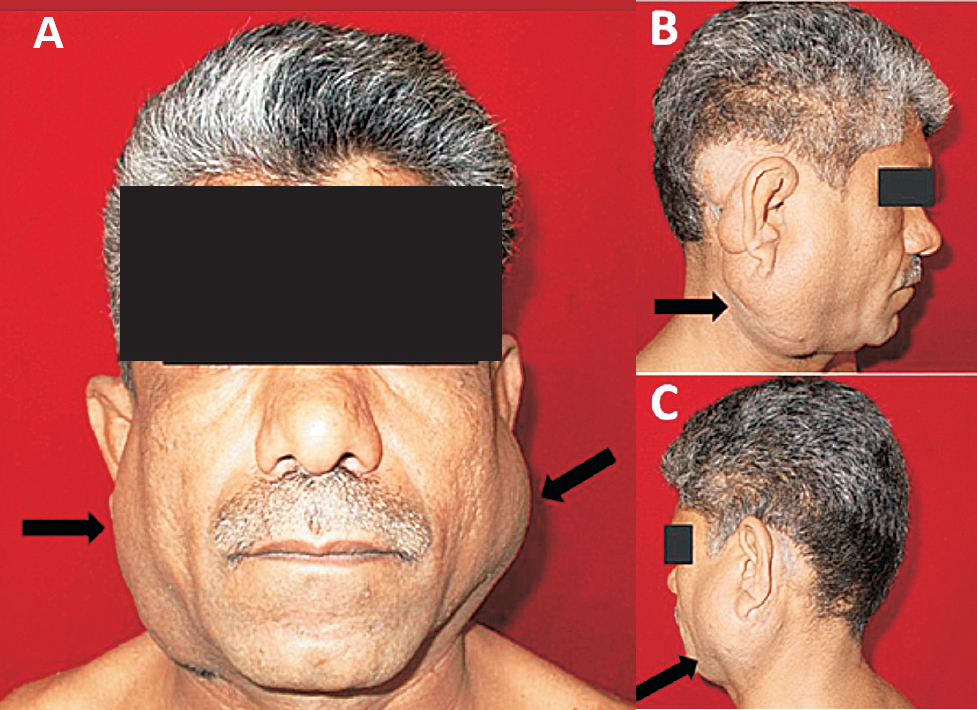 (1A - Front view, 1B - Right lateral view, 1C - Left lateral view) shows bilateral infra-auricular swellings due to Kimura disease (arrows)