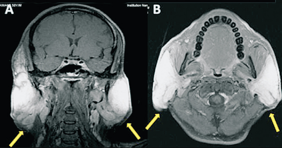 MRI images (2A - axial section and 2B - transverse section) of the patient showing bilateral infra-auricular enhancing lesions (arrows)