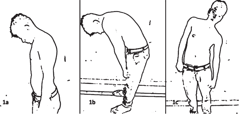 Line diagrams showing antecollis (a), camptocormia (b) and Pisa syndrome (c).