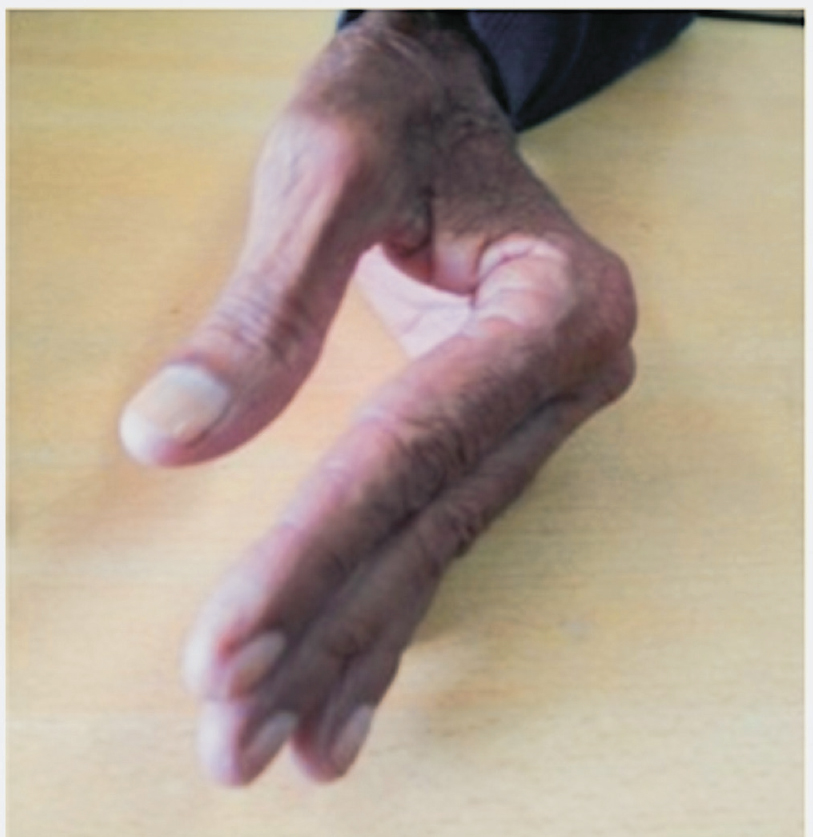 Striatal deformity of left hand characterized by flexion at metacarpophalangeal joint in a Parkinson's disease patient (71 yr old male).