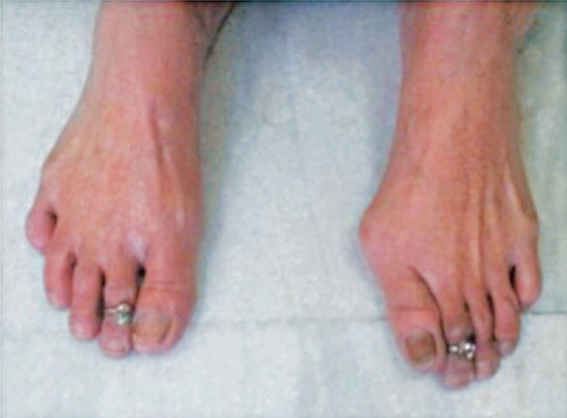Striatal deformity of left foot characterized by big toe lateral flexion in a Parkinson's disease patient (66 yr old female).