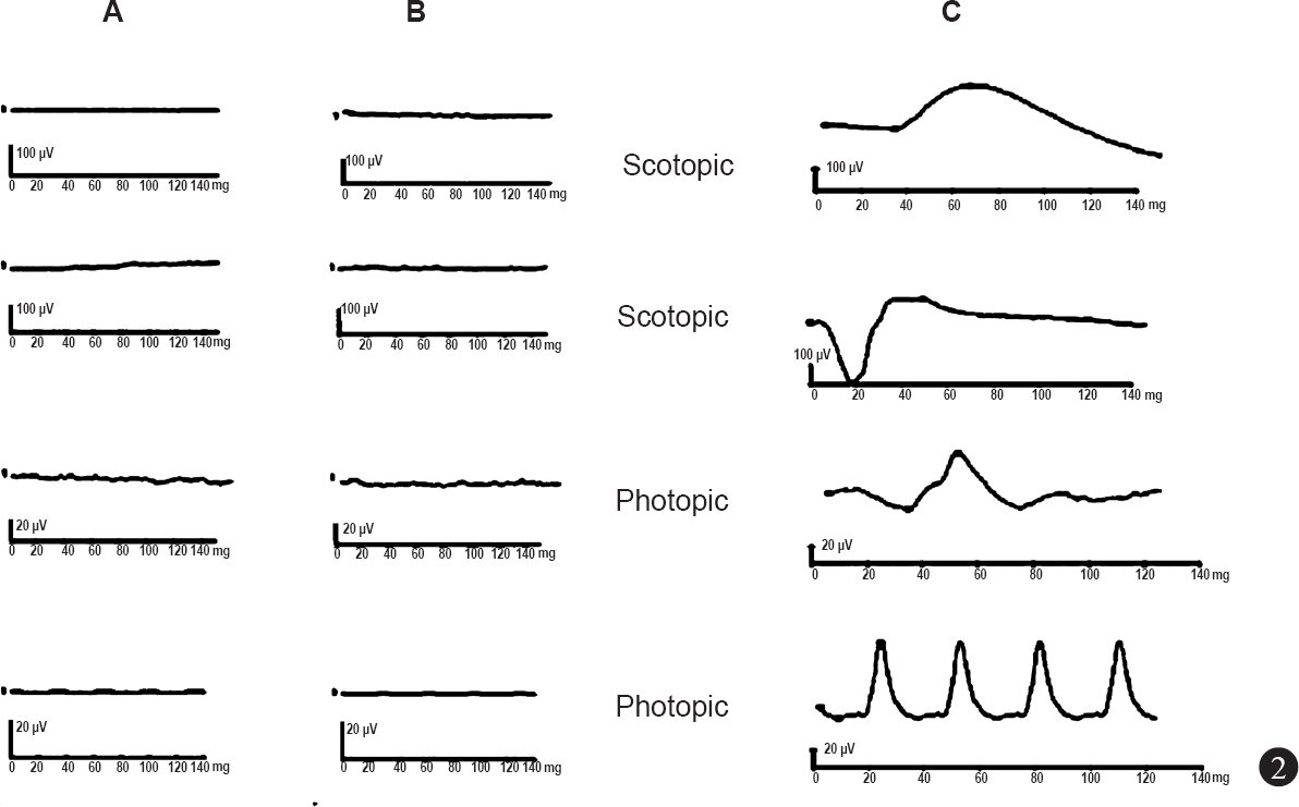 A, B. Full field electroretinogram (ERG) of right (A) and left (B) eye shows extinguished scotopic and photopic responses. Fig. 2C shows ERG responses in normal eye.