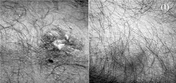 Photomicrographs of the skin lesions showing a 2 × 2.5 cm ulcer with clean base and serous discharge over the left thigh. Multiple 2 × 3 cm reddish non-pruritic papules were present over both lower limbs and abdomen.
