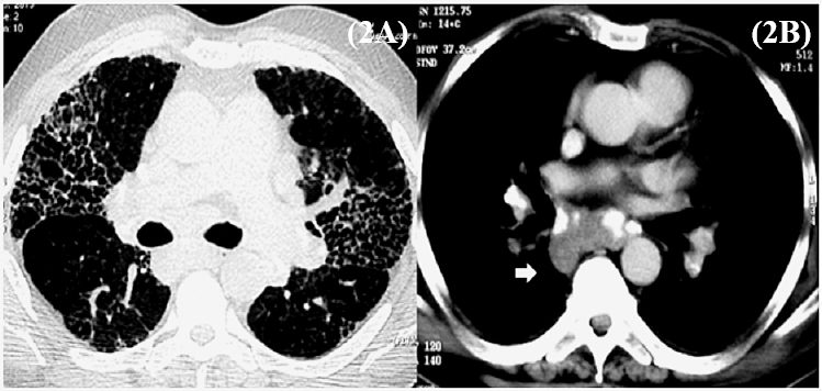 Computed tomography (CT) of chest confirmed upper lobe predominant honey-combing and septal thickening (A) and large calcified right paratracheal, sub-carinal, bilateral hilar and paraaortic lymphadenopathy (B) consistent with prior diagnosed stage IV sarcoidosis. No cavitation, consolidation or evidence of pulmonary nocardiosis was seen.