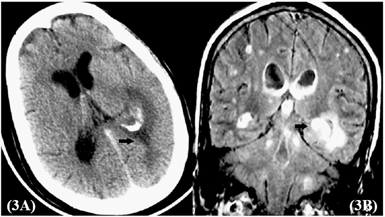 Contrast enhanced computed tomography (CECT) of the head shows an enhancing hypoattenuated lesion over the left parietal lobe (a black arrow in Fig. 3A). Magnetic resonance imaging (MRI) of the head showing multiple enhancing ring lesions (arrow) in the cerebrum, cerebellum and brain stem (B) which were hyperintense on T1 and T2-weighted images with extension into the lateral ventricles.