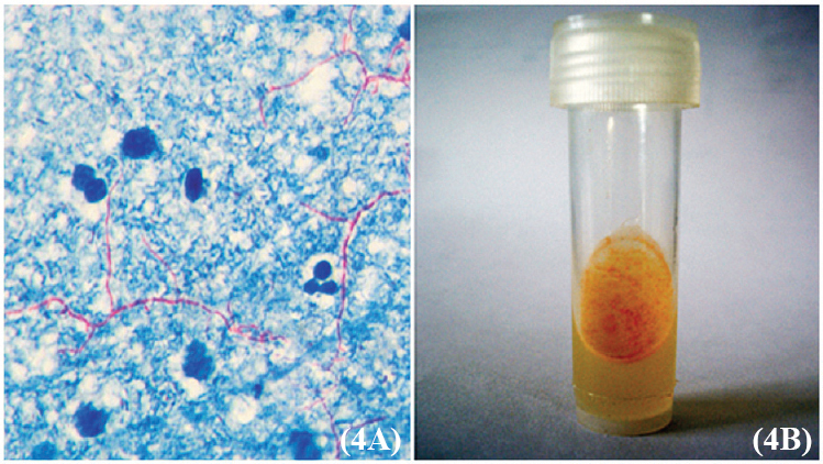 (A). Modified acid-fast staining (× 40) of the aspirate from the discharging ulcer showing presence of long thin filamentous forms suggesting Nocardia. Cultures grew buffy colonies (B) that were typed biochemically as Nocardia asteroides.