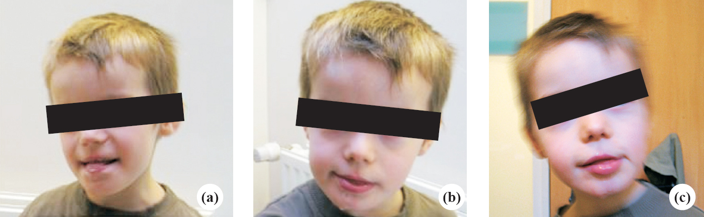 Three photographs (a, b and c) of patient II-4, the images show the phenotype which involves a large forehead, hypertelorism, small nose, depressed nasal bridge, anteverted nares, tended upper lip and averted lower, an open mouth with drooling and a pragmatism.