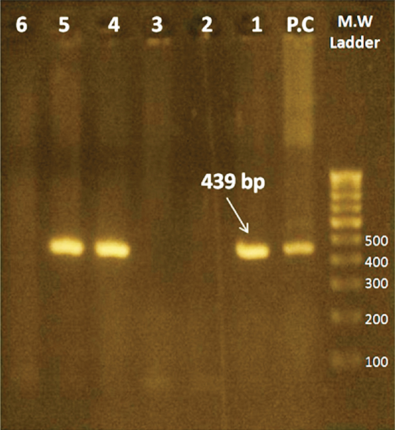 Agarose gel electrophoresis of amplicons from nested-multiplex PCR, showing M.W. marker-DNA molecular weight marker [represented in base pairs (bp)], P.C - Positive control (Eh - HM1:IMSS strain), Lanes 1, 4 and 5-Positive test samples, Lanes 2, 3 and 6 - Negative test samples.