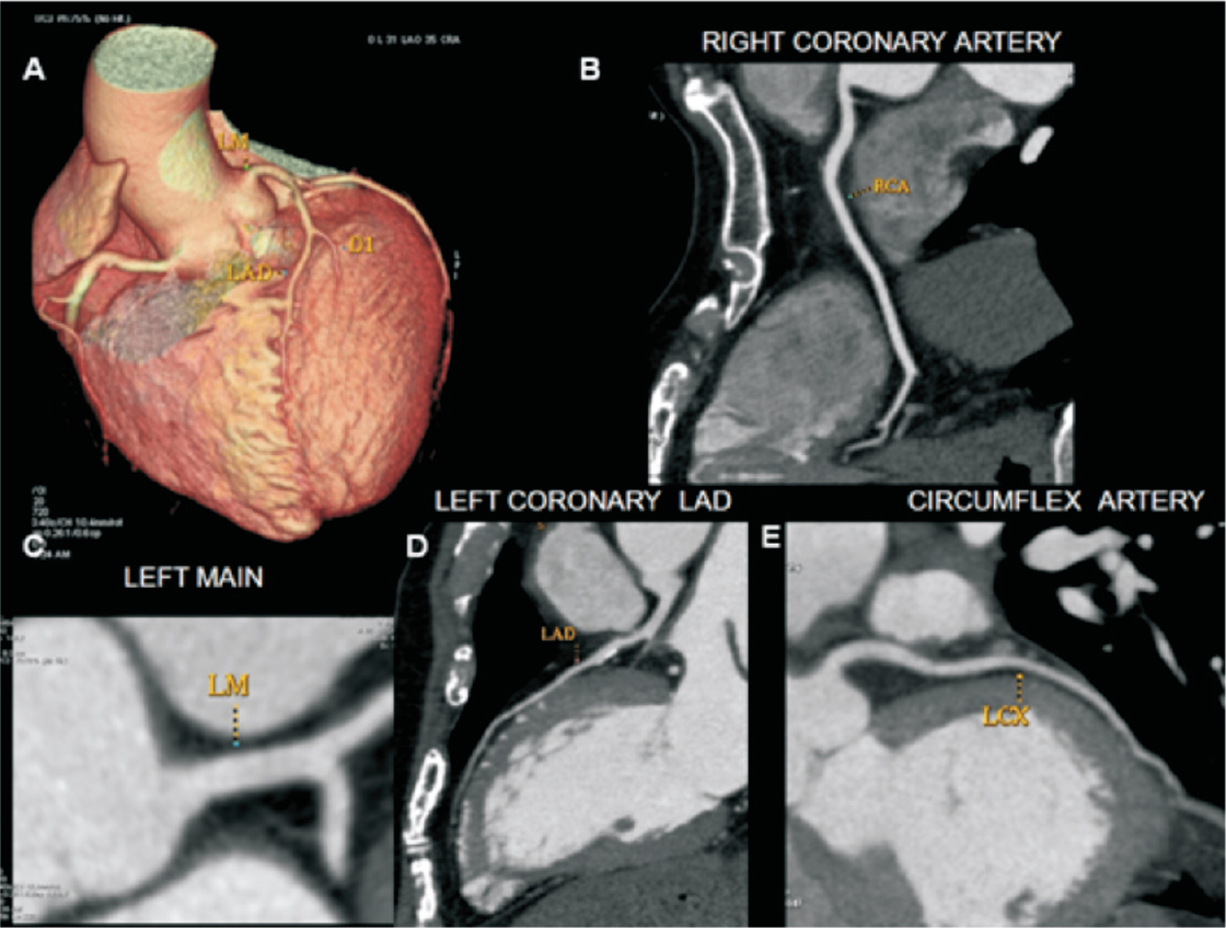 Multidetector computed tomography (MDCT) reconstructed images (A) Surface rendered volumetric image, (B) Reconstructed image of right coronary artery, (C) Left main coronary artery (LM), (D) Left anterior descending artery (LAD), and (E) Circumflex branch of left coronary artery (LCX). Illustrated arteries are analyzed for calcification, luminal narrowing and occlusion.