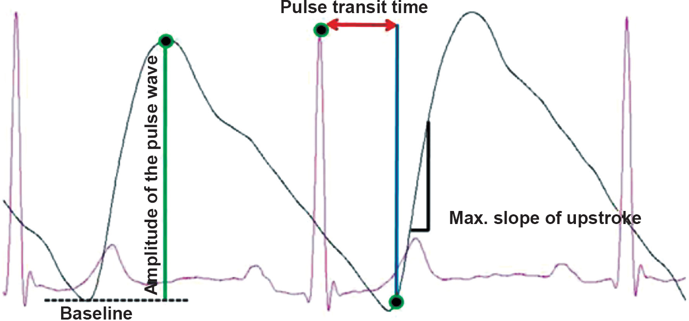 Figure shows overlapped and magnified image of simultaneously acquired lead II ECG and photoplethysmography (PPG) signals labelled with various function parameters.