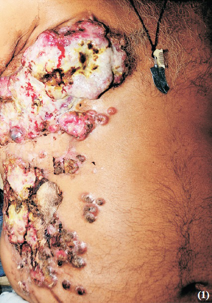 Multiple nodular and nodulo-ulcerative lesions exclusively involving the right chest wall and abdomen with destruction of the nipple-areola complex. The largest lesion on the chest shows central puckering.