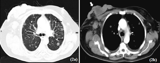 Lung window of CECT chest showing multiple, rounded, nodular lesions (arrows) suggestive of metastases (b). Mediastinal window of CECT chest showing heterogenous attenuation soft tissue mass lesion involving right breast (arrow).