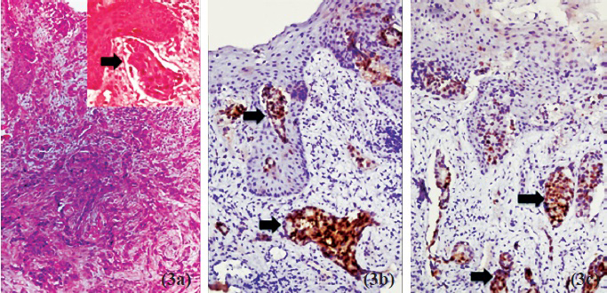 Microphotograph of skin biopsy showing tumour infiltrating the dermis with desmoplasia and lymphovascular emboli (inset, arrow) (a, H&E x 10x, 40x). The tumour cells showed uniform positive staining for oestrogen (b), and progesterone (c) receptor (arrow) (DAB-Brown x 20x).