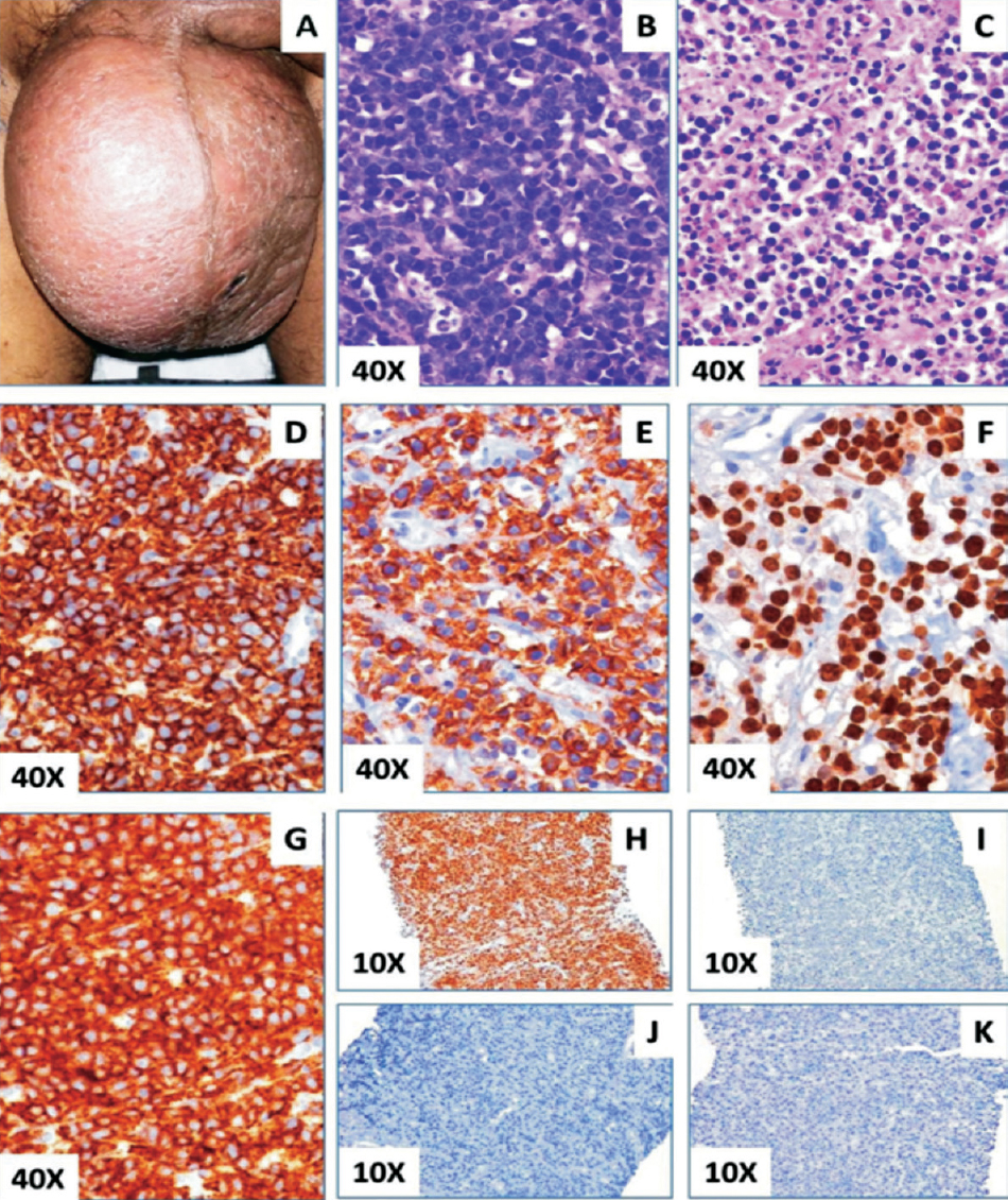 (A). Clinical picture shows left orchidectomy with enlarged right testes. (B) Testicular core biopsy showing uniform population of large cells with round nuclei, coarse chromatin and prominent nucleoli (Hematoxylin and Eosin, 40x). (C) Testicular core biopsy showing areas of necrosis and inflammatory infiltrate (Hematoxylin and Eosin, 40x). Testicular biopsy showing plasmablastic lymphoma, tumour cells were positive (brown colour) for CD45 (D), CD138 (E), Ki-67 (F), EMA (G) (40x) and MUM-1 (H) (10x) and negative for CD30 (I), Cytokeratin (J) and PAX-5 (K) (10x) [DAB staining].