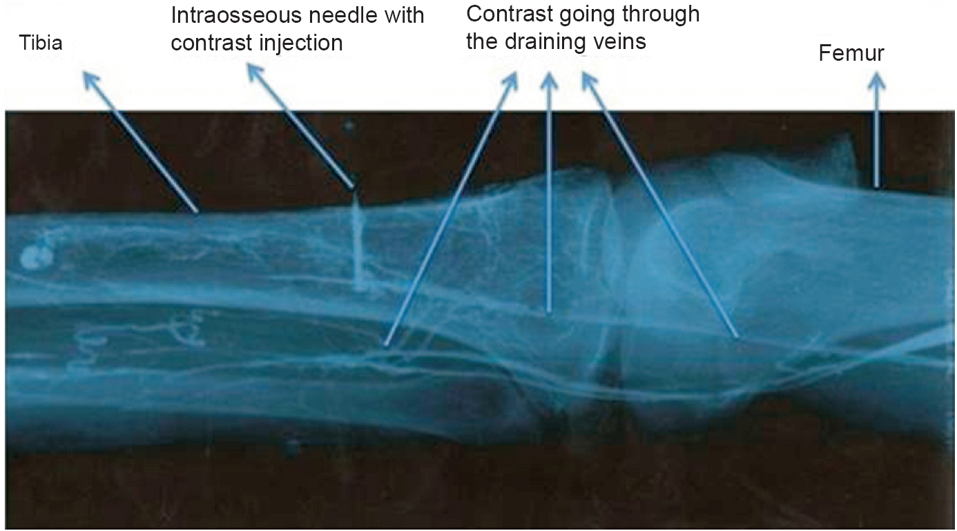 Radiograph after contrast injection of a successful intraosseous device insertion. The needle was placed in the intra-medullary space of proximal tibia. The draining veins of the bone getting opacified in this radiograph.