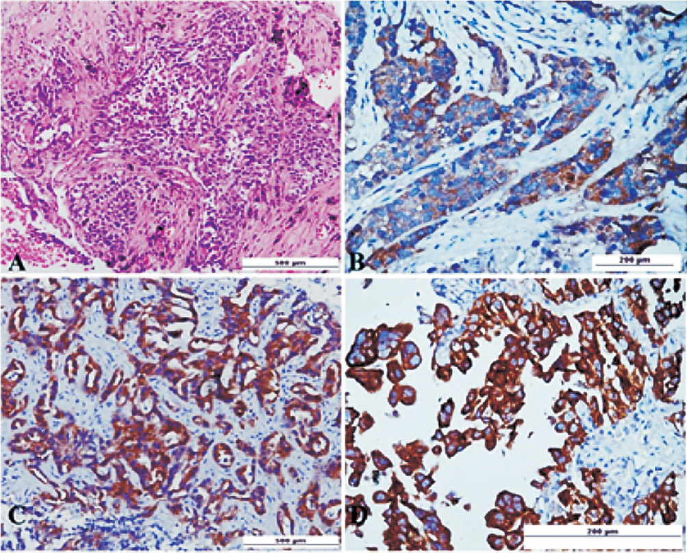 (A). Photomicrograph of biopsy from the mass lesion in lung shows an invasive adenocarcinoma H&E x 20. (B) EGFR del E746-A750 IHC shows weak cytoplasmic staining without membrane accentuation scored as 1+ original magnification x10. (C) EGFR L858R IHC shows moderate intensity of cytoplasmic staining with rare membrane reactivity scored as 2+ original magnification x20. (D) EGFR del E746-A750 IHC shows strong cytoplasmic positivity with diffuse membrane staining scored as 3+ original magnification x10.