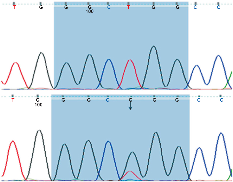 Sequencing chromatograms of exon 21: Upper panel; Wild type and Lower panel; Arrow indicating L858R mutation.