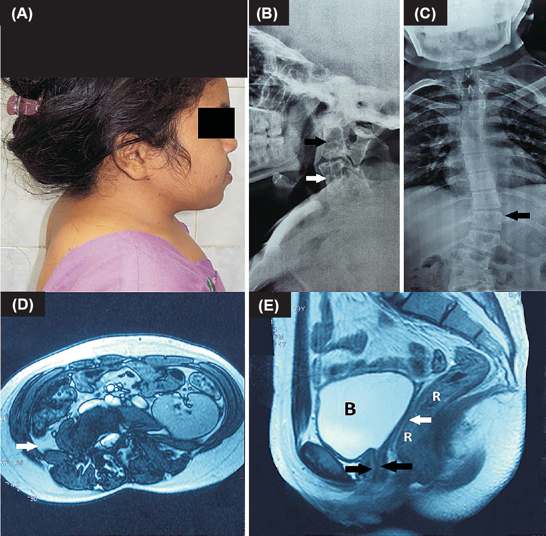 (A). Patient profile showing Turner like dysmorphia as evidenced by short neck and multiple facial nevi; (B). X-ray neck showing type-II Klippel Feil anomaly characterized by fusion of C2-C4 vertebrae (black arrow) and C5-C7 vertebrae (white arrow); (C). X-ray dorsolumbar spine showing scoliosis (black arrow) (D). Magnetic resonance imaging (MRI) abdomen showing right renal agenesis as evidenced by absence of kidney in right renal fossa (white arrow). Left kidney was malrotated; (E). MRI pelvis showing anterior and posterior lips of lower one third of vagina (black arrows), with absence of upper two-third of vagina, cervix and uterus (Mullerian agenesis) between bladder (B) and rectum (R) (white arrow).