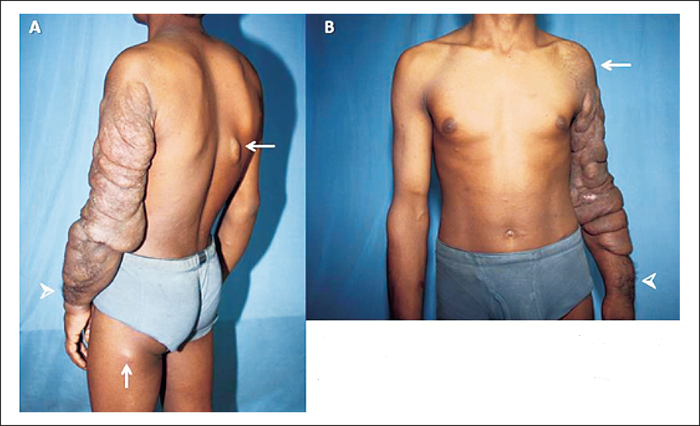 Patient of plexiform neurofibromatosis presenting with multiple café-au-lait macules, neurofibromas (Fig. A arrows), plexiform neurofibroma with hypertrichosis in the upper limb (Fig. A & B arrowheads) and hyperpigmentation (Fig. B arrow).