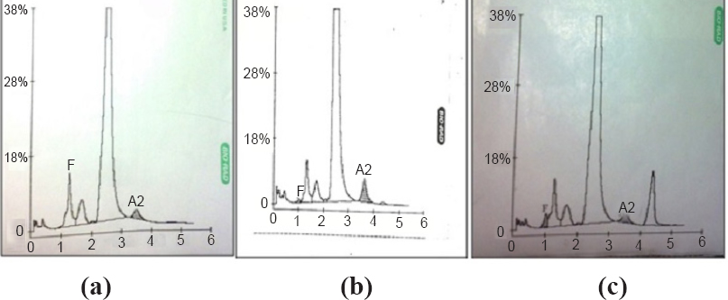 (a). HPLC chromatogram of a normal individual (A2- 2.1%; HbF-0.0% both A2 and HbF are in the normal range), (b) HPLC chromatogram of a β-thalassaemia carrier (A2-4.3%; HbF-0.4% A2 is high), (c) HPLC chromatogram of a sickle cell carrier (HbS- 8.8%; HbF-1.7% HbS in high range).