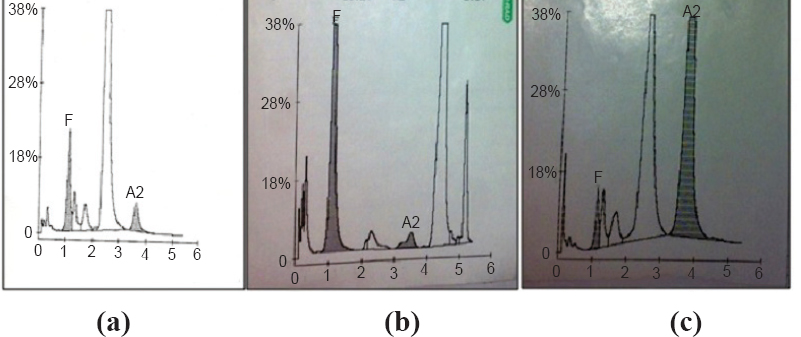(a). HPLC chromatogram of a β-thalassaemia major (the chromatorgram is of a transfused beta thalassaemia major (A2-7.5%; HbF-3.7% both A2 and HbF are high), (b) HPLC chromatogram of a sickle cell anaemia (HbS-39.4%; HbF-10.6% both HbS and HbF are in high range), (c) HPLC chromatogram of a E-disease (A2-48.3%; hbF-3.9% A2 is too high HbF also high).