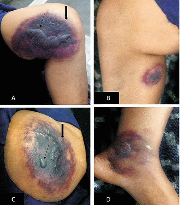 Well defined violaceous patches (thick black arrow) with central bullae formation (thin black arrow). The lesion is surrounded with peripehral rim of erythematous patch. (A) Left thigh, (B) Right thigh, (C) Abdomen, (D) Left foot.