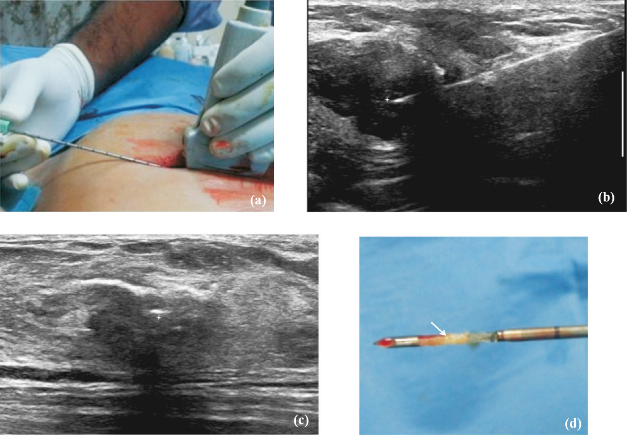 Technique of ultrasound guided biopsy. (a) After preliminary scanning to determine appropriate approach to the lesion, local anaesthesia is administered at the skin entry site and biopsy needle is advanced into the lesion under real time ultrasound guidance. (b) The position of the needle tip (star) is confirmed to be within the lesion in two orthogonal planes. (c) The position of the needle tip (star) is confirmed to be within the lesion in two orthogonal planes. (d) Biopsy is obtained, the core (arrow) is harvested from the sample notch and put into a formalin bottle.