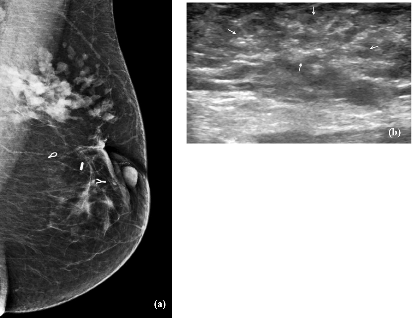 Mucinous carcinoma diagnosed on image guided biopsy. (a) Mammogram (Rt MLO view) of a 34 yr old lady presenting with a recurrent palpable lump shows lobular high density mass in the upper outer quaderant. (Surgical clips are also seen). (b) Ultrasound shows a poorly defined, isoechoic mass lesion (marked by arrows). Palpation guided biopsy was reported as chronic inflammation, assessed as discordant with imaging findings. Repeat ultrasound guided biopsy correctly diagnosed it to be mucinous carcinoma.