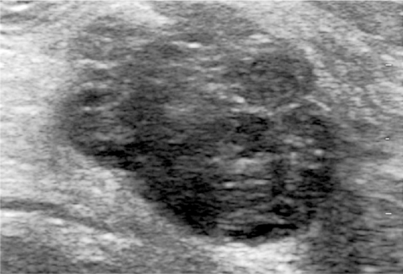 Ultrasound image of a 38 yr old lady presenting with a palpable lump shows an irregular, heterogenous, predominantly hypoechoic mass. Palpation guided biopsy was inconclusive and ultrasound guided biopsy was reported as fibroadenoma.