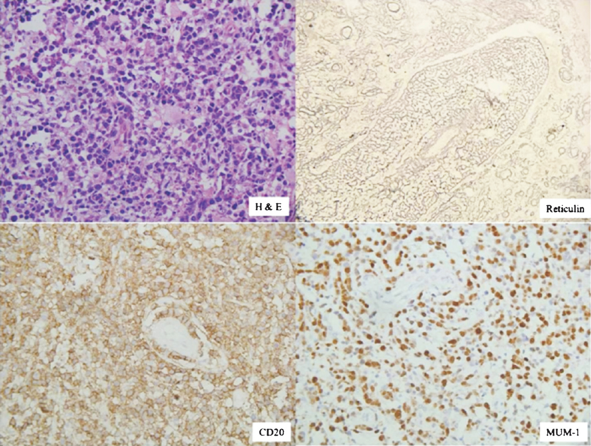 Showing H&E staining of non-germinal centre (NGC) diffuse large B cell lymphoma (DLBCL) with immunopositivity for CD20, MUM-1 and reticulin rich network (X 200 each). DAB was used as chromogen.
