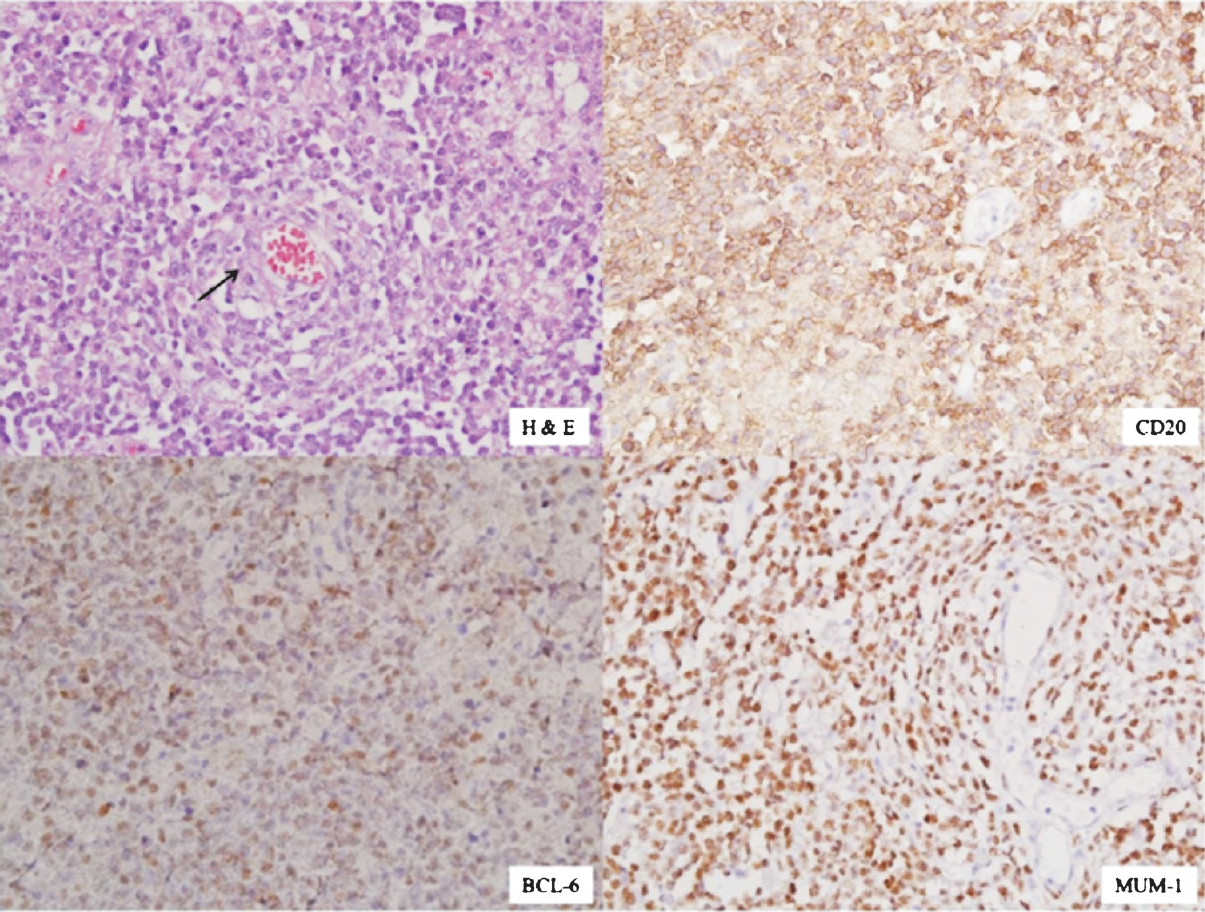 Non-germinal centre (NGC) diffuse large B cell lymphoma (DLBCL) showing perivascular cuffing of the tumour cells in H&E staining (arrow) with immunopositivity for CD20, Bcl-6 and MUM-1 (X 200 each). DAB was used as chromogen.