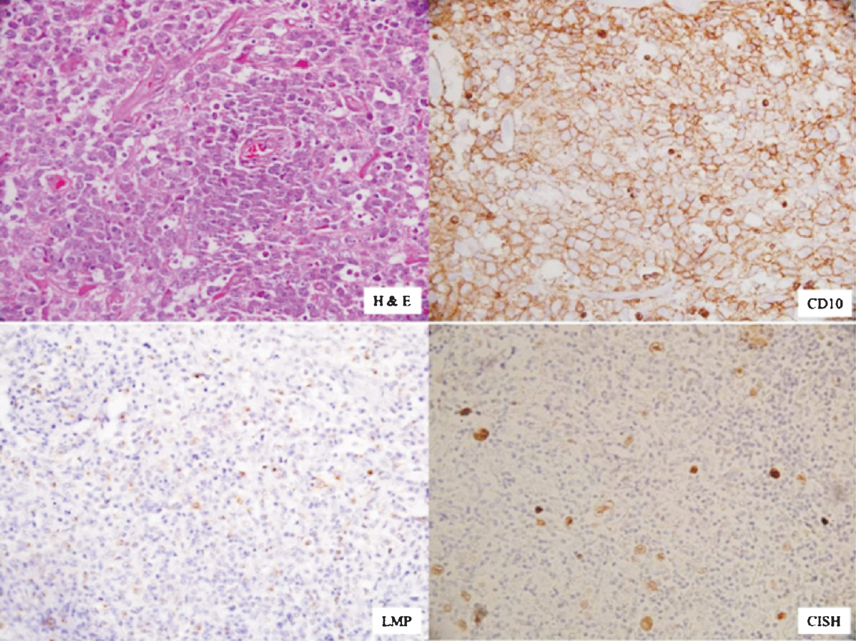 Showing H&E staining of GC DLBCL with immunopositivity for CD10, LMP-1 (cytoplasmic) and chromogenic in situ hybridization (CISH) positivity (nuclear) for EBV(X 400 each). DAB was used as choromogen.