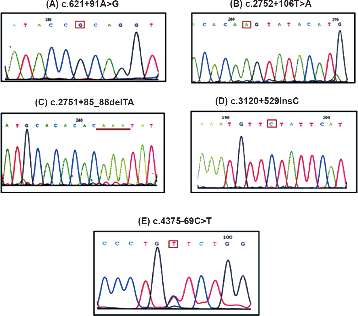 Identification of novel variants in infertile males with CBAVD and renal anomalies. (A) c.621+91A>G (intron 4); (B) c.2752+106T>A (intron 14A); (C) c.2751+85_88 delTA (intron 14A); (D) c.3120+529 InsC (intron 19); (E) c.4375-69C>T (intron 23).