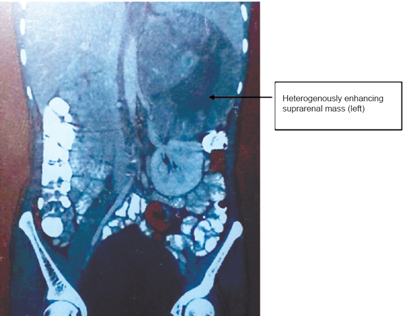 CT scan showing large well defined heterogeneously enhancing mass in left suprarenal region with loss of fat planes between the mass, spleen and left kidney.