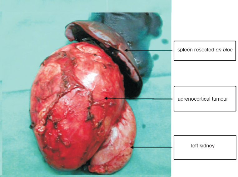 Post-operative specimen showing the adrenal tumour attached to left kidney and spleen.