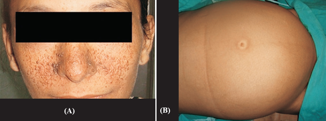 Clinical photograph showing multiple adenoma sebaceum around nose and bilateral malar regions (A) and protuberant abdomen (B).