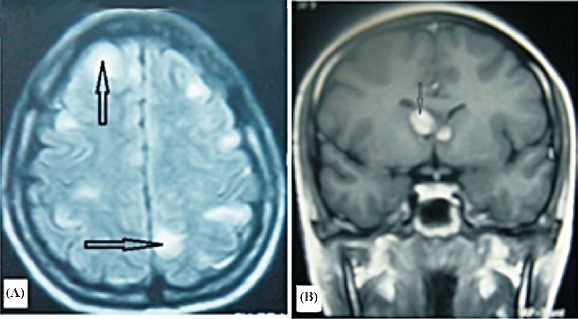 Magnetic resonance imaging (MRI)-brain. (A) Multiple cortical tubers in cerebrum (black arrows). (B) Multiple subependymal nodules, largest at right side of foramen of Monro (black arrow).