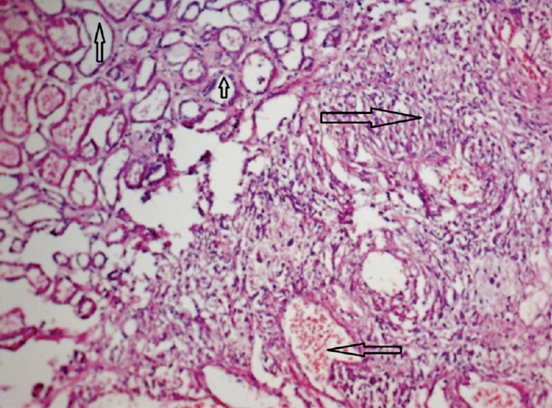 Light microscopy (H&E, 100X) revealed combination of fat cells (upward arrows), smooth muscle component (right hand arrow) and blood vessels (left hand arrow).