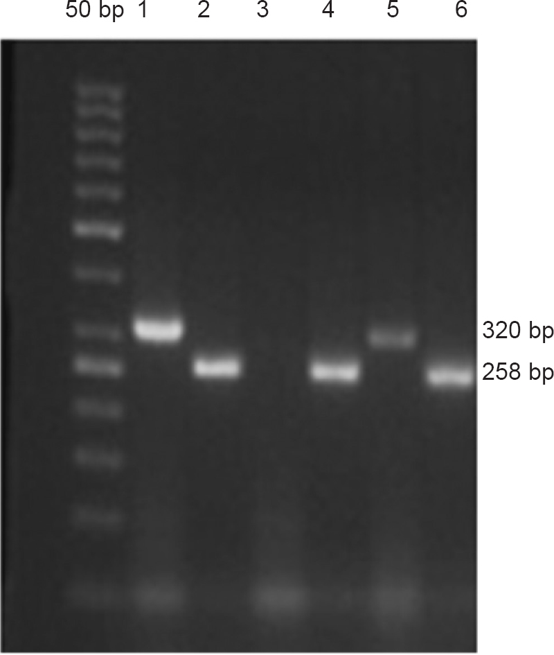 Agarose gel (2%) electrophoresis of ASO-PCR amplified products: An amplification band of 320 bp containing the NPM1A mutation is visualized in two patient samples (lanes 1 and 5), whereas no amplification signal is visible in one patient sample (lane 3). Successful amplification of the ABL gene was used in all cases as internal PCR control (lanes 2, 4 and 6).