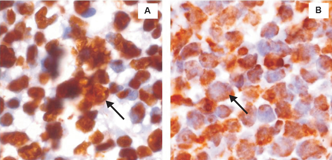 (A). Leukaemic cells from bone marrow biopsy of patient with acute myeloid leukaemia with wild-type NPM1 show nucleus-restricted NPM staining (arrow) (x1000). (B). Bone marrow biopsy from an NPMc+ patient with AML bearing NPM mutation A. Leukaemic cells show cytoplasmic expression of NPM (arrow) (x1000).