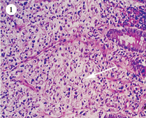 Histopathological examination revealed the colonic signet-ring cell carcinoma (arrow) (Hematoxylin-eosin staining; original magnification×200).
