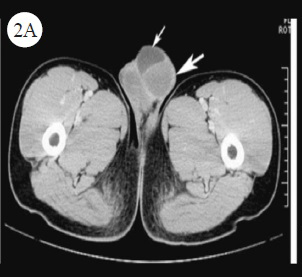 CT showed the only hydrocele of tunica vaginalis (thin arrow) and the normal shape of testis (thick arrow) in the left scrotum during December 2010.