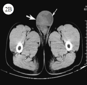 CT showed a 6.8×4.5cm mixed density mass shadow with ill-defined margin in the left scrotum, and above which a cystic shadow with watery density in May 2014. CT diagnosis was left testis tumour (thick arrow) and hydrocele of tunica vaginalis (thin arrow).
