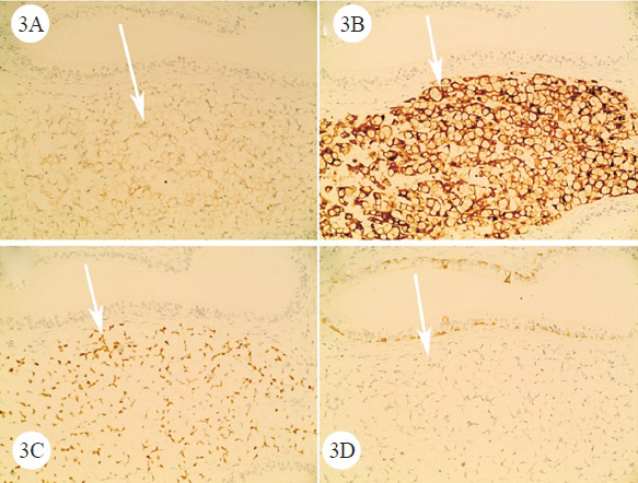 A-D. Immunohistochemistry (IHC) staining showed that the tumour cells were positive for cytokeratin (CK) 20 (A) (arrow), Villin (B) (arrow), caudal-related homeobox transcription factor 2 (CDX2) (C) (arrow), but negative for CK7 (D) (arrow) (DAB staining; original magnification ×200).