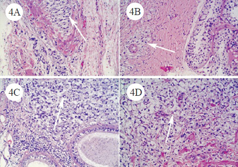 A, B, C, D. Histopathological examination revealed metastatic colonic signet-ring cell carcinoma to the left tunica vaginalis testis (A) (arrow), tunica albuginea testis (B) (arrow), epididymis (C) (arrow) and spermatic cord (D) (arrow) (Hematoxylin-eosin staining; original magnification×200).