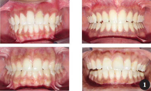 Grade 0 - Normal appearance of enamel in children with normal teeth.