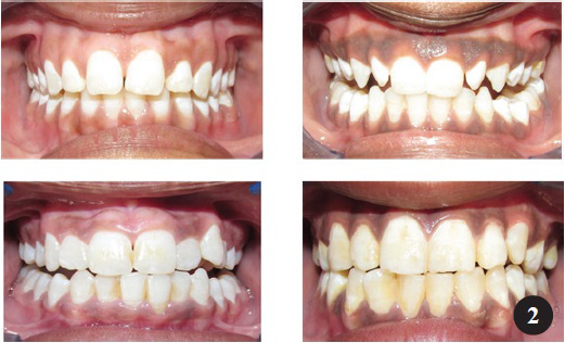 Grade 1- Mild fluorosis cases among the children examined.