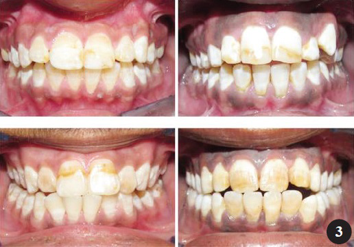 Grade 2 - Moderate fluorosis cases among the children examined.